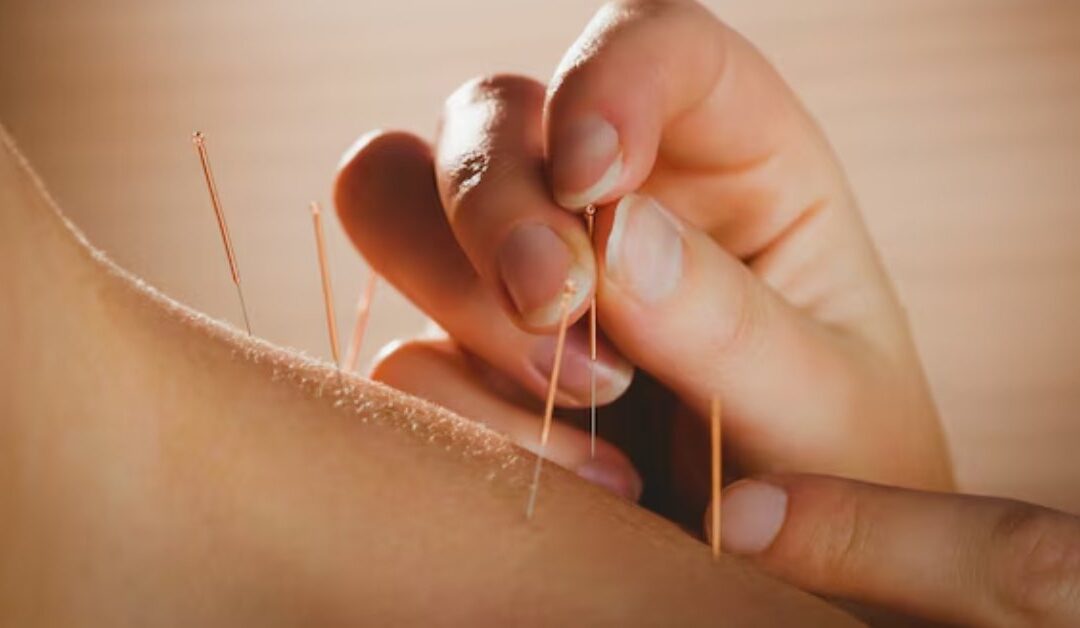 Acupuncture for Mental Health Support