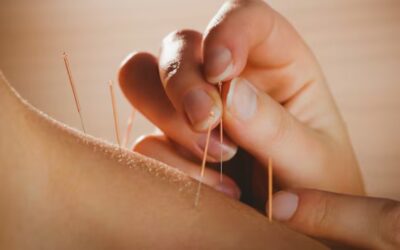 Acupuncture for Mental Health Support